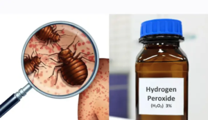 does peroxide kill bed bugs